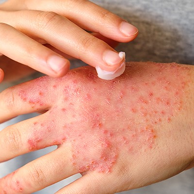 Pepti-Cell dermatitis and eczema care